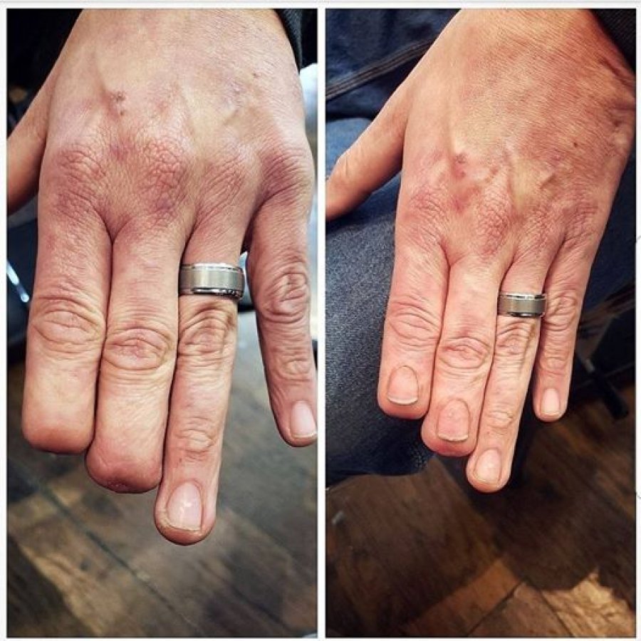Tatto majstor "vratio" nokte muškarcu na odsječenim prstima